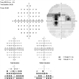 Plaquenil Toxicity